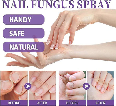 Fungus Nail Treatment Spray – Restore Healthy Nails Fast!