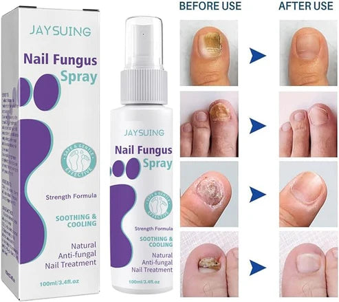 Fungus Nail Treatment Spray – Restore Healthy Nails Fast!